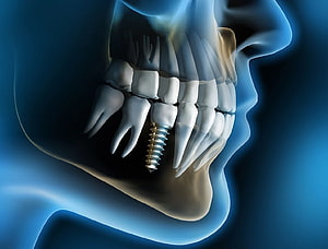 3D Medical Illustration of Dental Implant Surgery in Human Jaw HD wallpaper