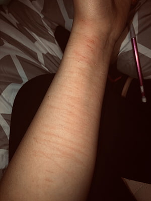 Close-up of a forearm with visible red linear marks and skin texture on a patterned bedsheet HD phone wallpaper