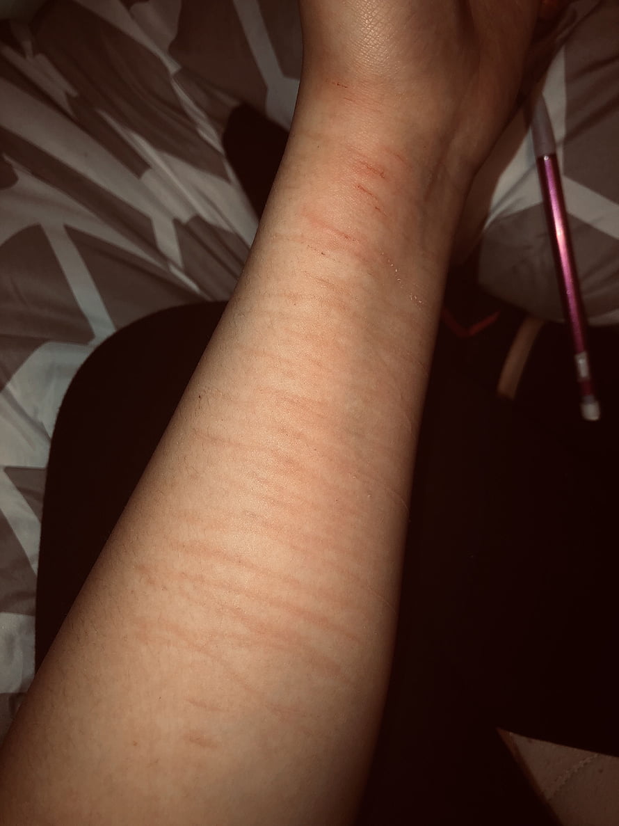 Close-up of a forearm with visible red linear marks and skin texture on a patterned bedsheet HD phone wallpaper